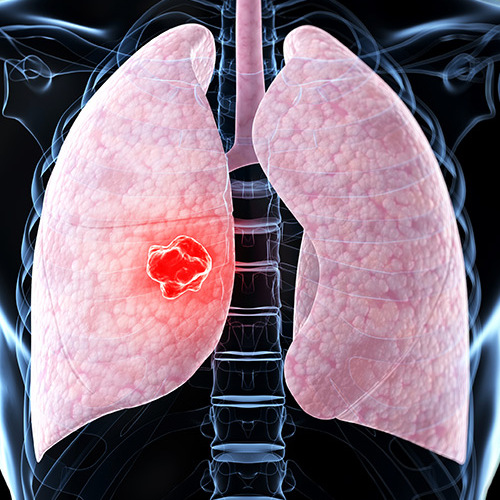 Реабилитация пациентов после перенесённых вирусной и бактериальной инфекции бронхов и лёгких